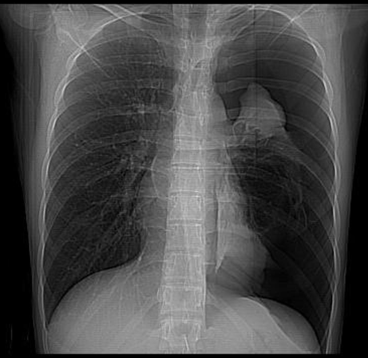 pneumothorax lung sounds